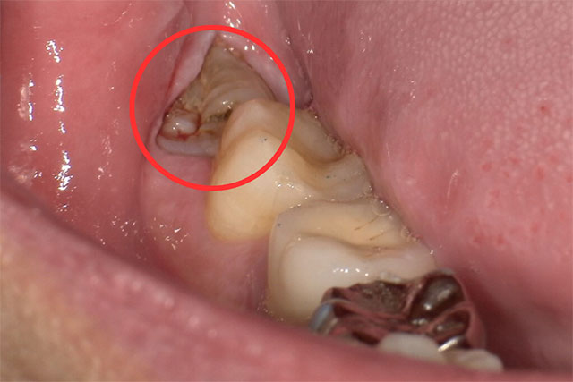 親知らずの抜歯