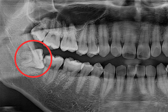 親知らずの抜歯