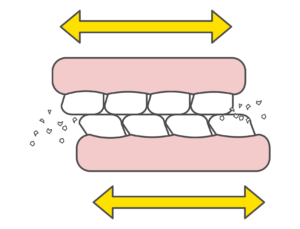 歯のすり減り　歯ぎしり　すり減り