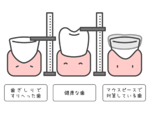 ナイトガード　歯ぎしり　マウスピース