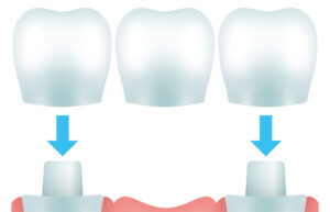 ブリッジ 費用 新宿