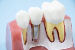 インプラント 費用 新宿